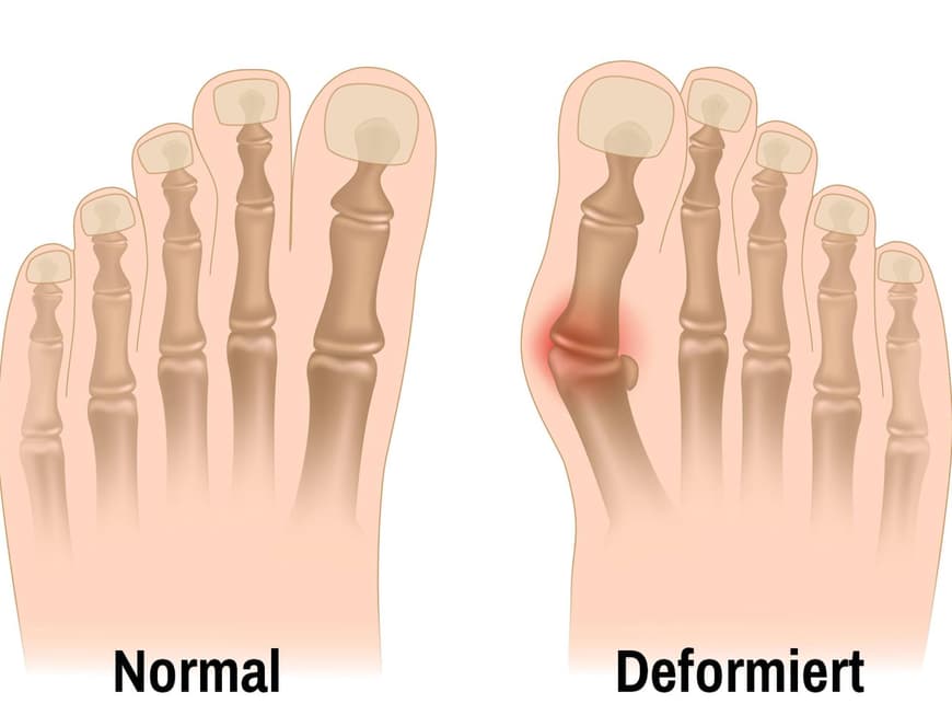 Grafik von normalem Fuß und Fuß mit Hallux valgus